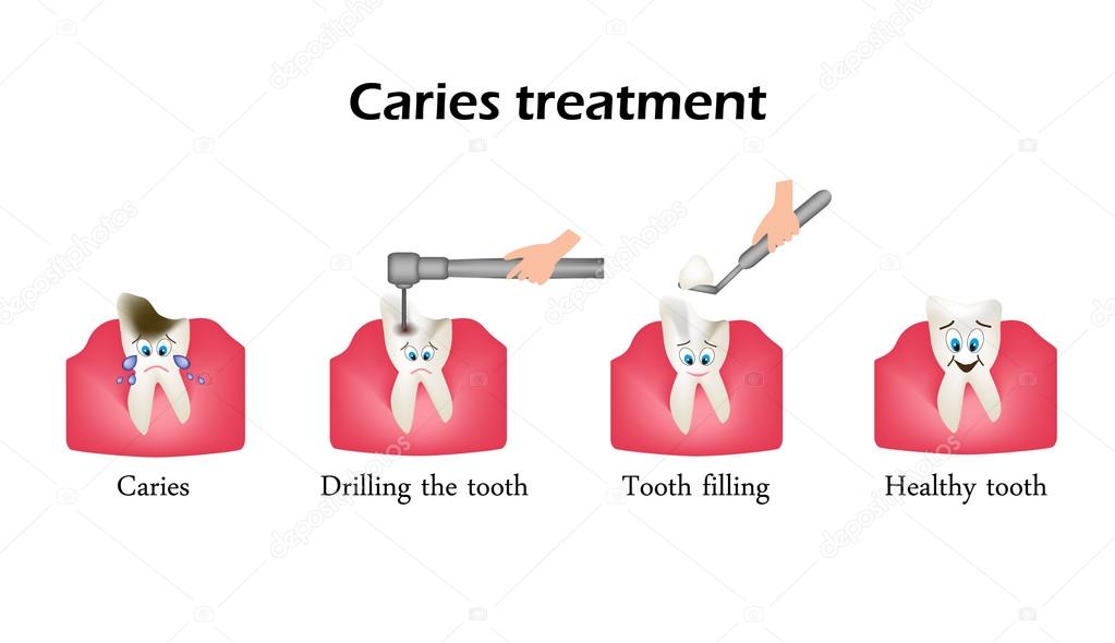 Treatment of caries. Drilling a tooth. Sealing of the tooth. Infographics. Vector illustration in cartoon style on isolated background