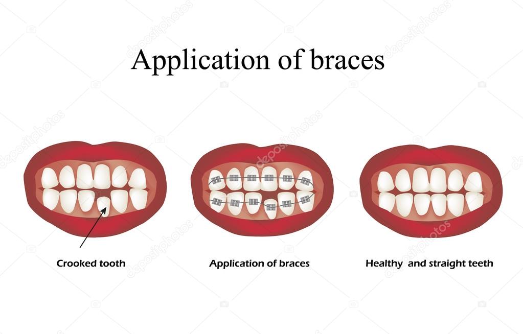 The use of braces. Crooked teeth. Orthodontics. Infographics. Vector illustration on isolated background