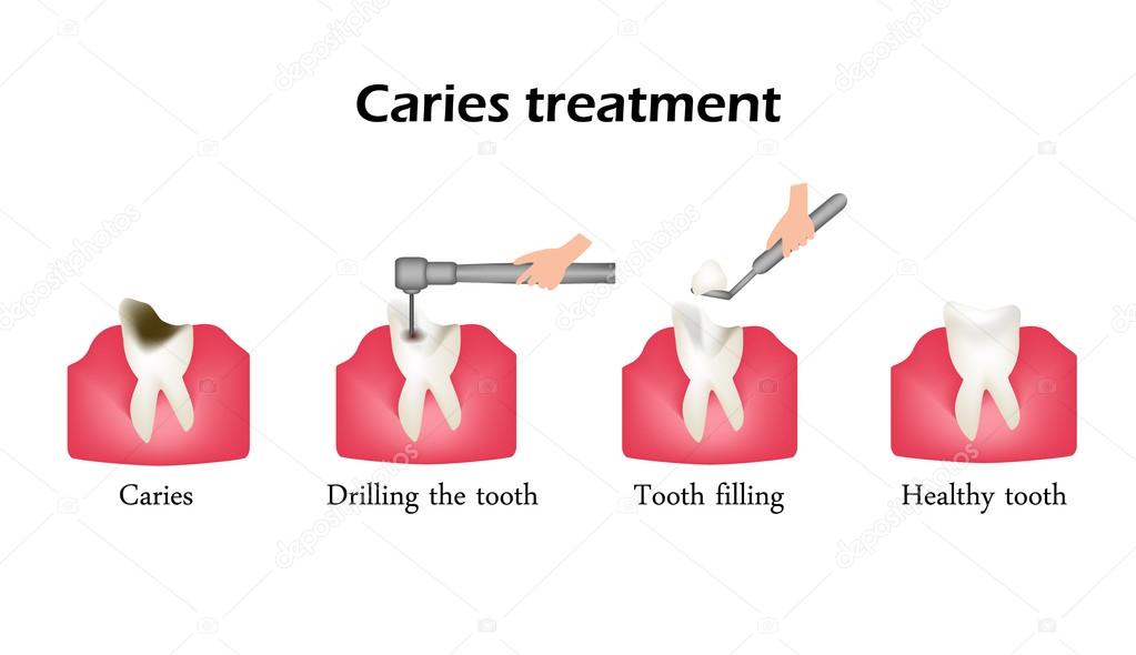 Treatment of caries. Drilling a tooth. Sealing of the tooth. Infographics. Vector illustration on isolated background