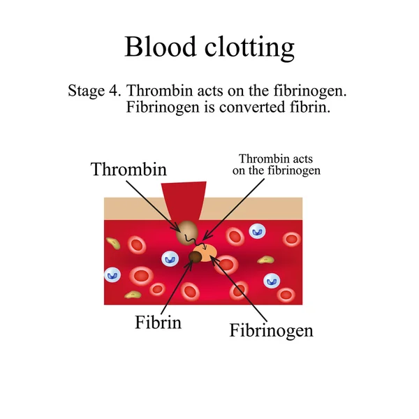 Coagulazione del sangue. Fase 4. Infografica. Illustrazione vettoriale . — Vettoriale Stock