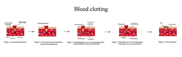 Blood clotting. Infographics. Vector illustration — Stock Vector