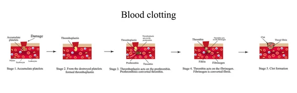 Згортання крові. Інфографіка. Векторні ілюстрації — стоковий вектор