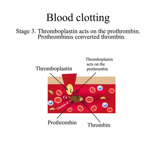 Blood clotting. Stage 3. Infographics. Vector illustration — Stock Vector