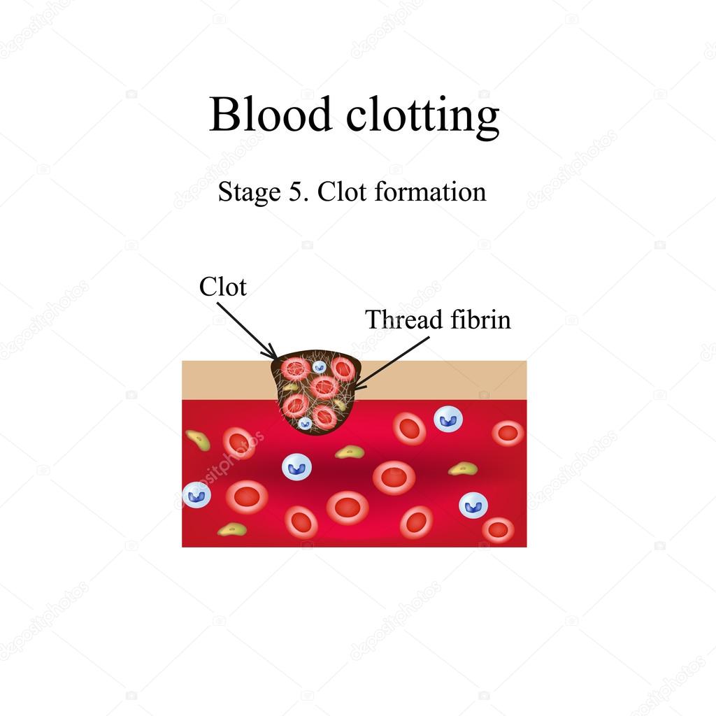 Blood clotting. 5 stage. Infographics. Vector illustration Stock Vector Image by ©mikrostoker #96401948 Blood clotting. 5 stage. Infographics. Vector illustration Stock Vector Image by ©mikrostoker #96401948