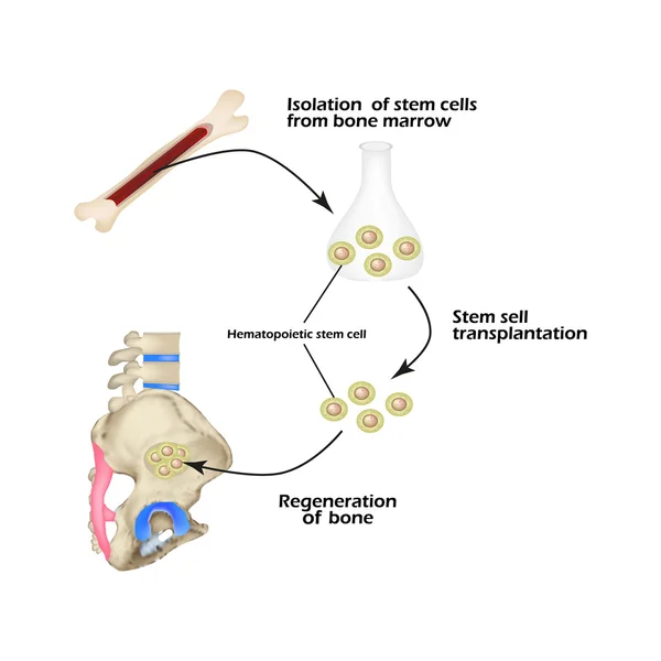 骨髄からの幹細胞は、骨の再生に使用されます。インフォ グラフィック。ベクトル図 — ストックベクタ