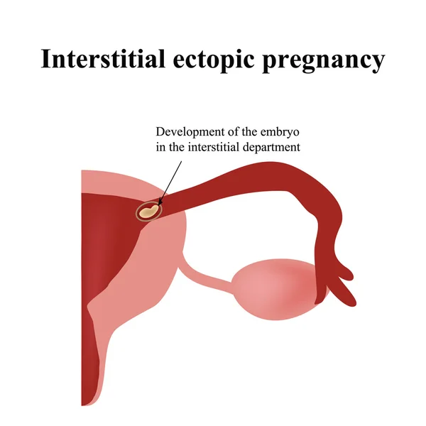 Entwicklung des Embryos in der interstitiellen Abteilung. Ektopische Schwangerschaft. Infografiken. Illustration auf isoliertem Hintergrund — Stockfoto