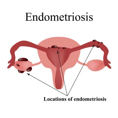 Endometriozis. Rahim kistleri. Pelvik organların yapısı. Kadın hastalıkları. Infographics. Vektör çizim