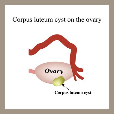 Corpus luteum kist yumurtalık üzerinde. Fonksiyonel kist. Yumurtalık. Infographics. Vektör illüstrasyon izole arka plan üzerinde