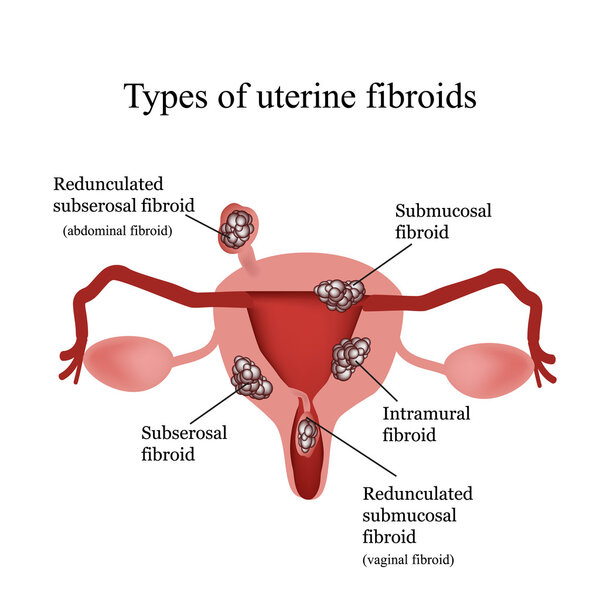 Types of uterine fibroids. Endometriosis. Infographics. Vector illustration isolated on white background