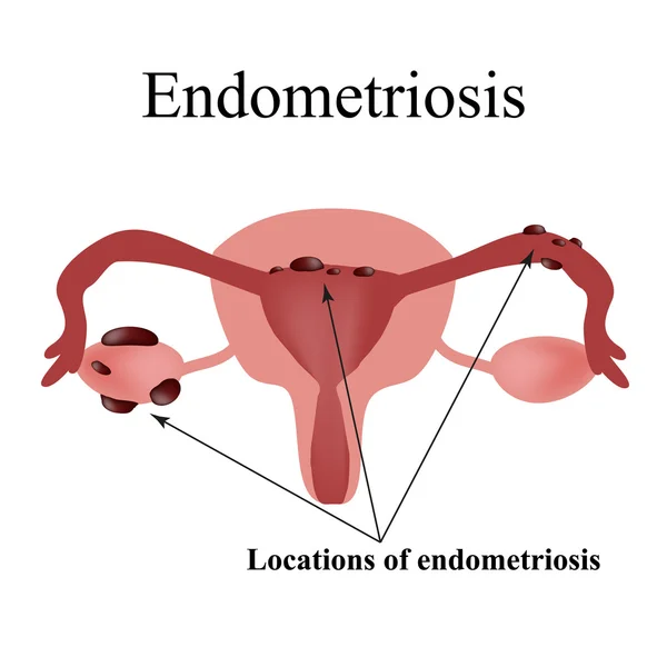 Endometriosis. Endometrium ciszták. A kismedencei szervek szerkezete. Nőgyógyászat. Infographics. Vektoros illusztráció — Stock Vector