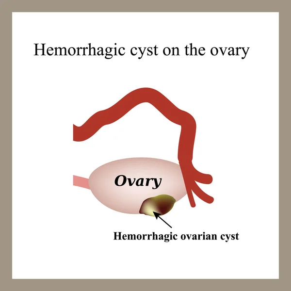 Cisti emorragica sull'ovaio. Ovaia. Infografica. Illustrazione vettoriale su sfondo isolato — Vettoriale Stock