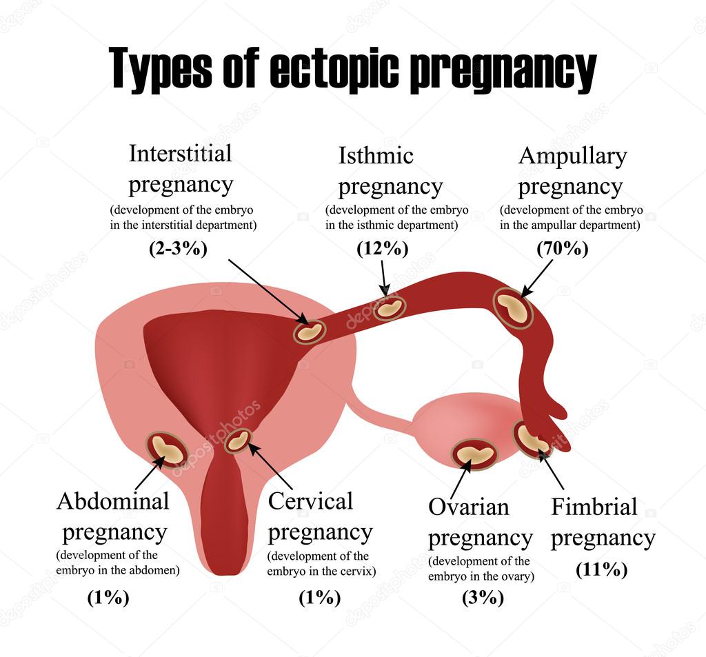 Types of ectopic pregnancy. Infographics. Vector illustration on isolated background.