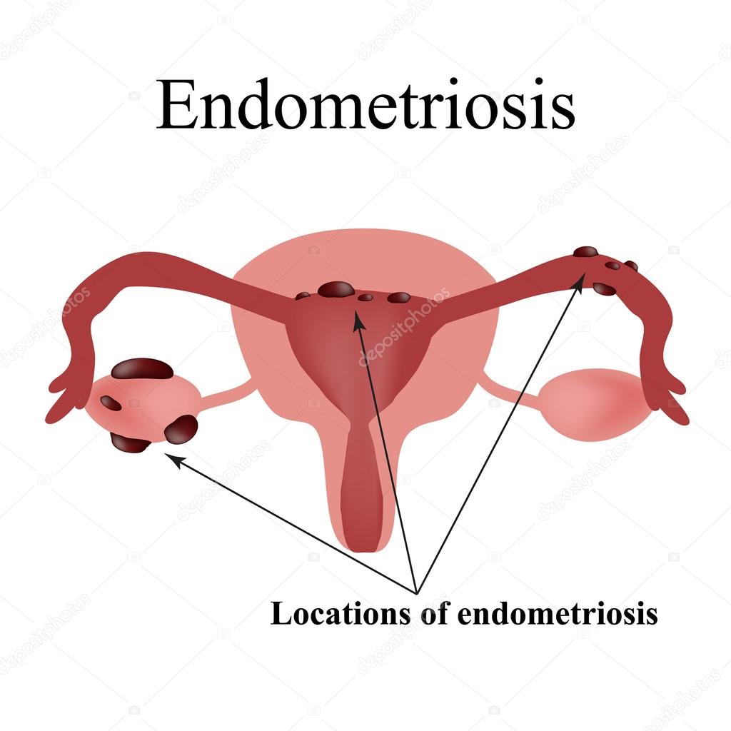 Endometriosis. Endometrial cysts. The structure of the pelvic organs. Gynecology. Infographics. Vector illustration