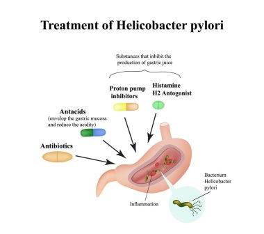 Helicobacter pylori tedavisinde. İlaçlar. Antasitler, proton pompa blokerler ve histamin H2 blokerleri. Infographics.