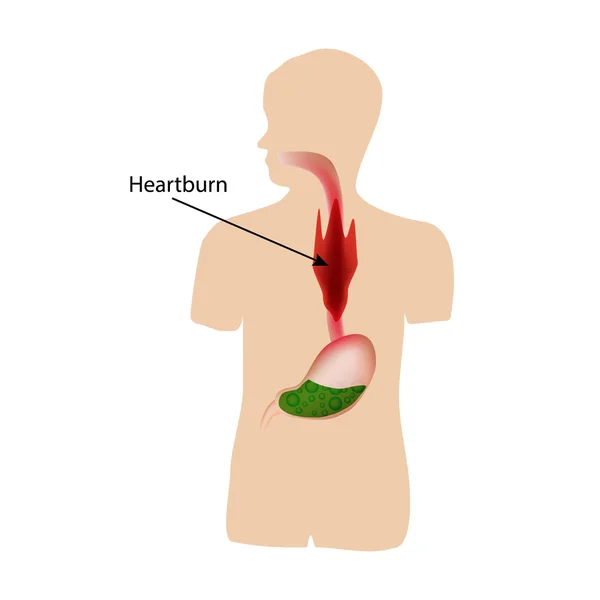 Halsbränna. Luften i magen. Strukturen i matstrupe och magsäck. Infographics. Vektor illustration — Stock vektor