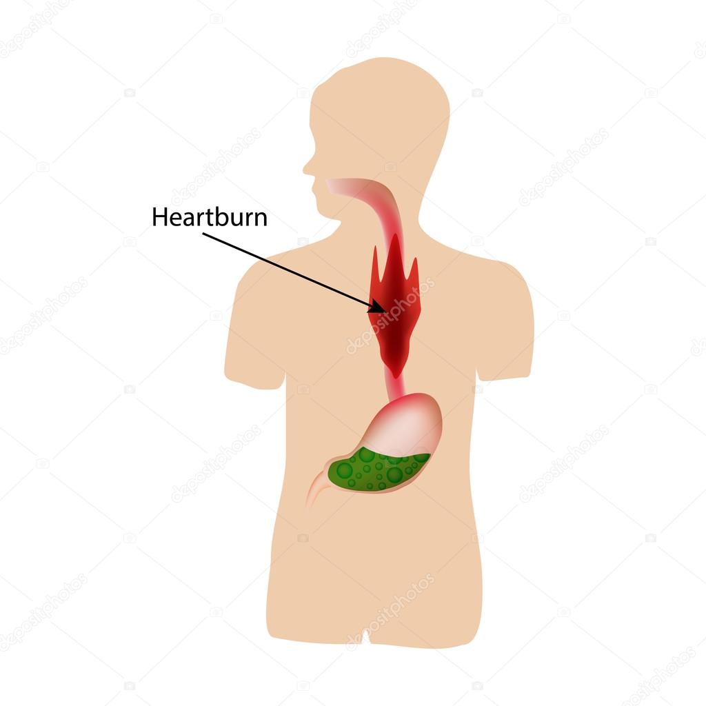 Heartburn. Air in the stomach. The structure of the esophagus and stomach. Infographics. Vector illustration