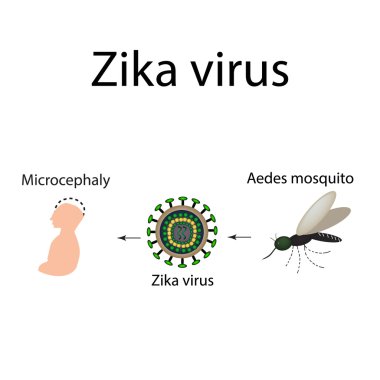 Zika virüs. Sivrisinek ısırığı. Microcephaly, bebek. Infographics. Vektör çizim