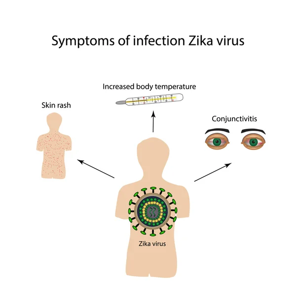 Virus Zika. Síntomas de infección. Infografías. Ilustración vectorial — Archivo Imágenes Vectoriales
