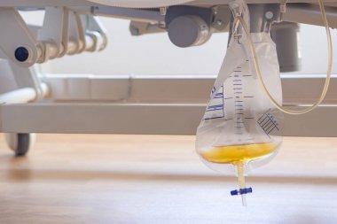 Hastanedeki odada hasta yatağının altında asılı bir idrar torbası. Hastanın akciğer taşkınlığı belirtileri var. Doktor idrar söktürücü vererek tedavi eder. Tıbbi bakım ekipmanları. Sağlık hizmeti kavramı