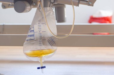 Hastanedeki odada hasta yatağının altında asılı bir idrar torbası. Hastanın akciğer taşkınlığı belirtileri var. Doktor idrar söktürücü vererek tedavi eder. Tıbbi bakım ekipmanları. Sağlık hizmeti kavramı