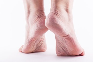 Dry heels woman on a white background closeup