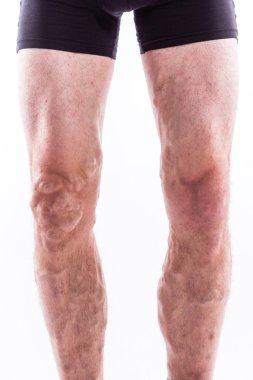 People with varicose veins of the lower extremities and venous t