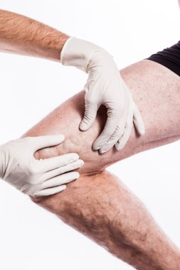 Doctor in medical gloves examines a person with varicose veins o