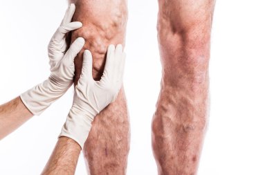 Doctor in medical gloves examines a person with varicose veins o