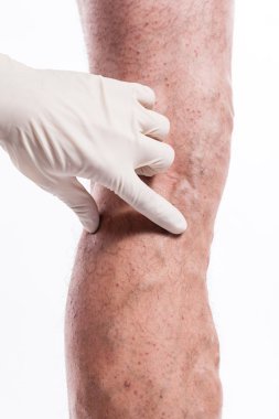 Doctor in medical gloves examines a person with varicose veins o