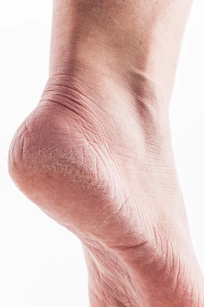 Dry heels woman on a white background closeup — Stock Photo, Image