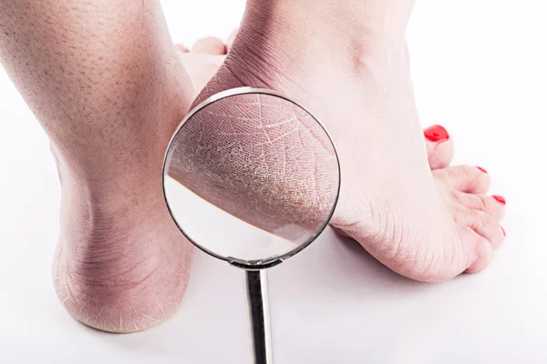 Dehydrated skin on the heels of female feet — Stock Photo, Image