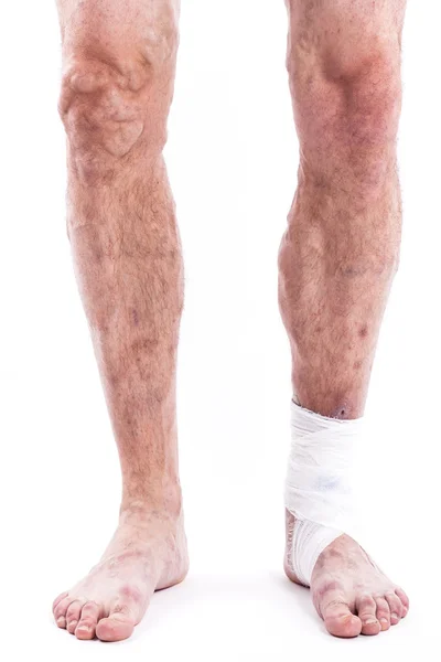 People with varicose veins of the lower extremities and venous t — Zdjęcie stockowe