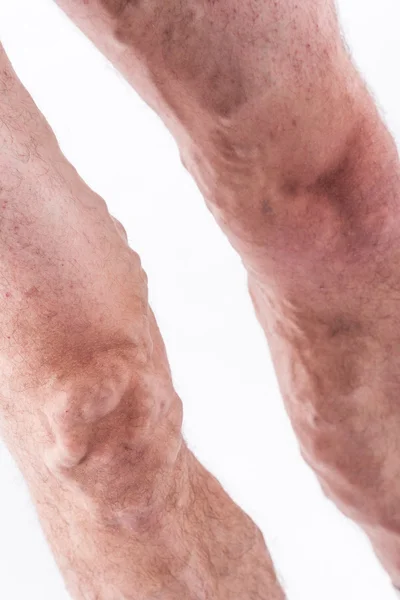 Personas con venas varicosas de las extremidades inferiores y t venosa — Foto de Stock