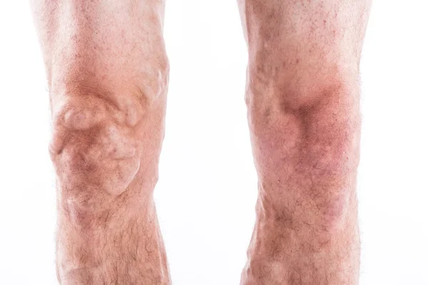 Persone con vene varicose delle estremità inferiori e venose — Foto Stock