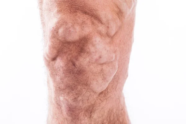Pessoas com varizes das extremidades inferiores e t venoso — Fotografia de Stock
