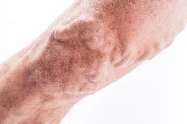 People with varicose veins of the lower extremities and venous t — Stock Fotó