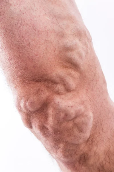 People with varicose veins of the lower extremities and venous t — Zdjęcie stockowe