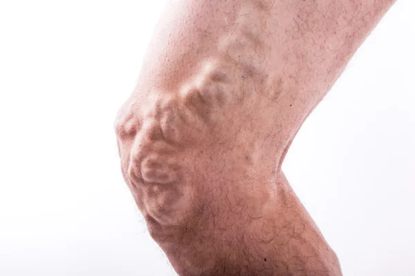 People with varicose veins of the lower extremities and venous t