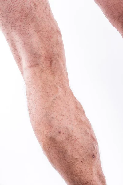 People with varicose veins of the lower extremities and venous t — Zdjęcie stockowe