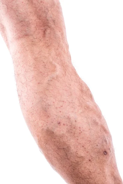 People with varicose veins of the lower extremities and venous t — Stock Fotó