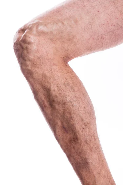 People with varicose veins of the lower extremities and venous t — Stock Photo, Image