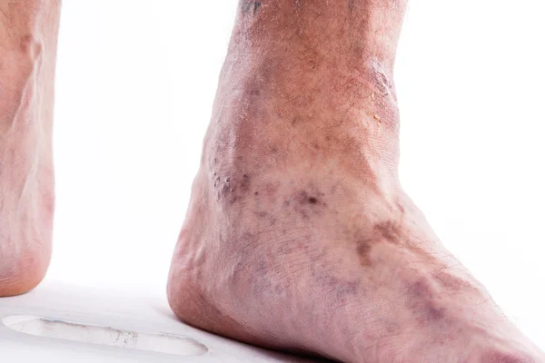 People with varicose veins of the lower extremities and venous t — Stockfoto