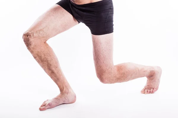 People with varicose veins of the lower extremities and venous t — Stok fotoğraf