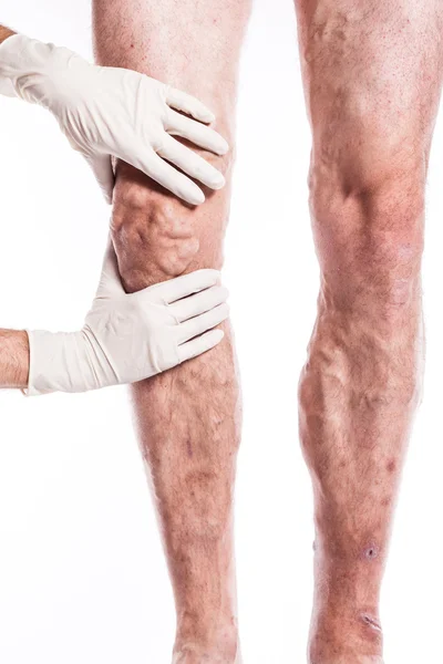 Врач в медицинских перчатках осматривает человека с варикозным расширением вен — стоковое фото
