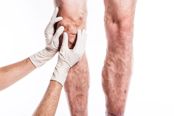 Doctor in medical gloves examines a person with varicose veins o