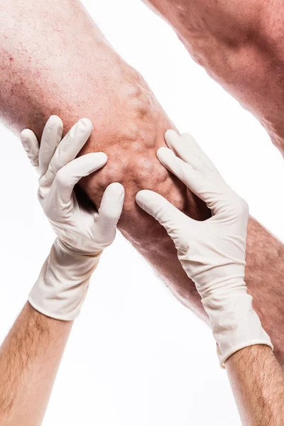 Doctor in medical gloves examines a person with varicose veins o — Stok fotoğraf