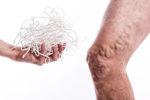 A tangle of ropes with a man being ill with varicose veins of th — Stock Photo, Image