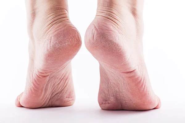 Dry heels woman on a white background closeup Royalty Free Stock Obrázky