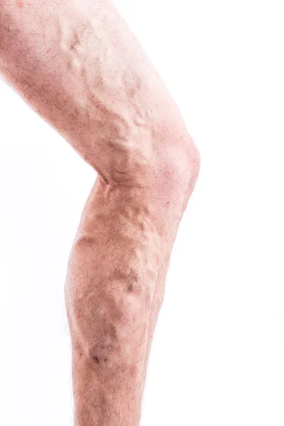 People with varicose veins of the lower extremities and venous t Stock Snímky