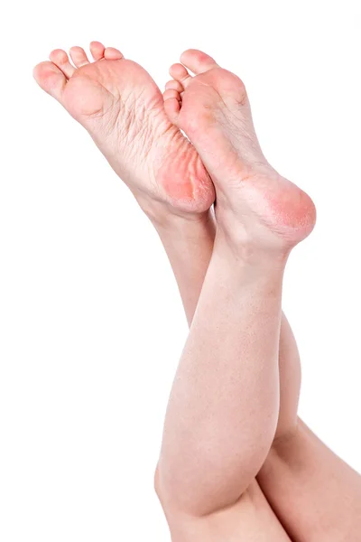 Dry dehydrated skin on the heels of female feet with calluses — Stock Photo, Image